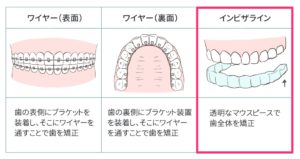 八重歯の全体矯正の表4
